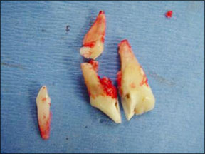 Canine Tooth Surgical Extraction