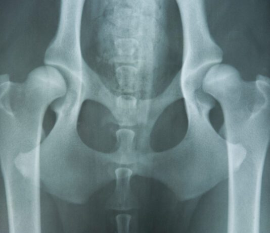 hip dysplasia