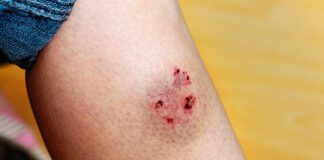 Woman's leg injured by a dog bite